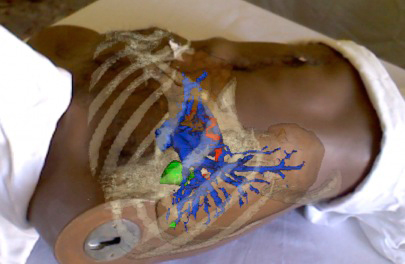 AR_liver