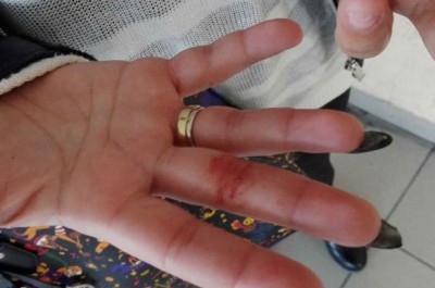 La denuncia shock su facebook: «Picchiata dal mio ex». Postate le foto delle ferite. Indaga la polizia - Corriere Salentino