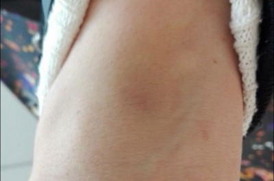 La denuncia shock su facebook: «Picchiata dal mio ex». Postate le foto delle ferite. Indaga la polizia - Corriere Salentino