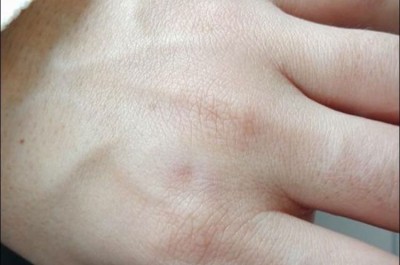 La denuncia shock su facebook: «Picchiata dal mio ex». Postate le foto delle ferite. Indaga la polizia - Corriere Salentino