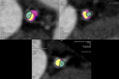 Nel Poliambulatorio Calabrese una Tac da 128 immagini al secondo: stop agli esami invasivi, precisione e tecnologia all'avanguardia - Corriere Salentino