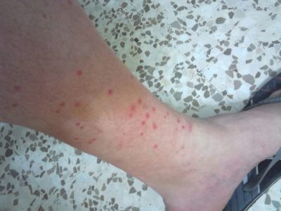 Case popolari infestate dalle pulci: un abitante finisce in ospedale - Corriere Salentino