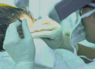 La Turchia è la meta preferita dagli italiani che vogliono sottoporsi al trapianto dei capelli