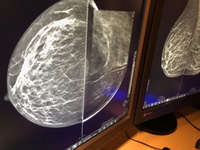 Mammografia 3 D, scoprire i tumori “invisibili": ecco come funziona e quando è necessaria la tomosintesi - Corriere Salentino