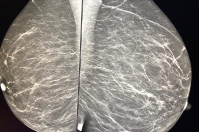 Mammografia 3 D, scoprire i tumori “invisibili": ecco come funziona e quando è necessaria la tomosintesi - Corriere Salentino