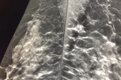 Mammografia 3 D, scoprire i tumori “invisibili": ecco come funziona e quando è necessaria la tomosintesi - Corriere Salentino