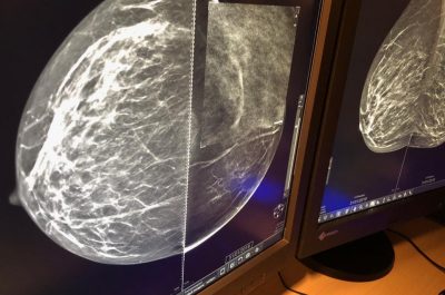 Mammografia 3 D, scoprire i tumori “invisibili": ecco come funziona e quando è necessaria la tomosintesi - Corriere Salentino