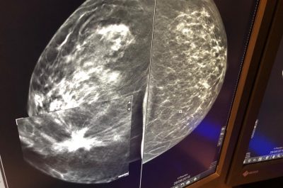 Mammografia 3 D, scoprire i tumori “invisibili": ecco come funziona e quando è necessaria la tomosintesi - Corriere Salentino