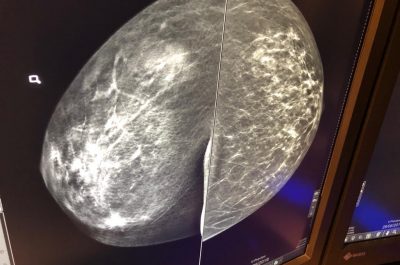 Mammografia 3 D, scoprire i tumori “invisibili": ecco come funziona e quando è necessaria la tomosintesi - Corriere Salentino