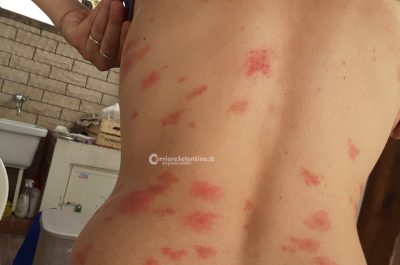 Vacanza da incubo: in sette assaliti da pulci e zecche, in ospedale anche bimba di 6 mesi - Corriere Salentino