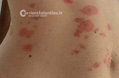 Vacanza da incubo: in sette assaliti da pulci e zecche, in ospedale anche bimba di 6 mesi - Corriere Salentino