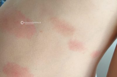 Vacanza da incubo: in sette assaliti da pulci e zecche, in ospedale anche bimba di 6 mesi - Corriere Salentino