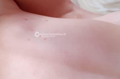 Vacanza da incubo: in sette assaliti da pulci e zecche, in ospedale anche bimba di 6 mesi - Corriere Salentino