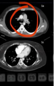 Confermate le affermazioni del dottor Palma: “Covid malattia vascolare che colpisce più organi” - Corriere Salentino
