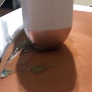 La verità sull’epilazione laser e falsi miti: possiamo dire addio ai peli anche in estate - Corriere Salentino