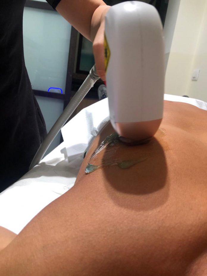 depilazione ano laser