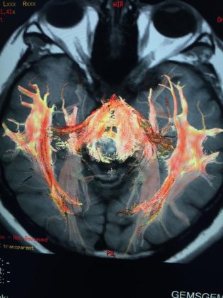 Neurostimolazione e neuromodulazione al servizio della neurologia, psichiatria e neuropsicologia nel Centro Calabrese - Corriere Salentino