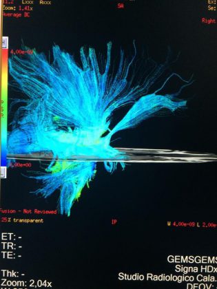 Neurostimolazione e neuromodulazione al servizio della neurologia, psichiatria e neuropsicologia nel Centro Calabrese - Corriere Salentino