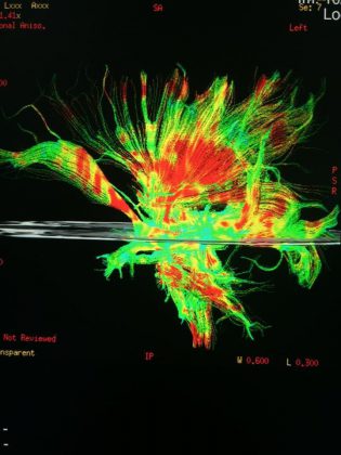 Neurostimolazione e neuromodulazione al servizio della neurologia, psichiatria e neuropsicologia nel Centro Calabrese - Corriere Salentino