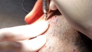 Trapianto dei capelli, il Salento si mette al passo. FUT e FUE: il dottor Sciannamea spiega le tecniche - Corriere Salentino