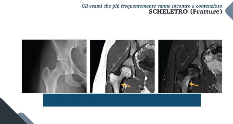 Le nuove frontiere della medicina forense. Gli infortuni ai raggi X: quando medico legale, avvocato e radiologo fanno gioco di squadra - Corriere Salentino
