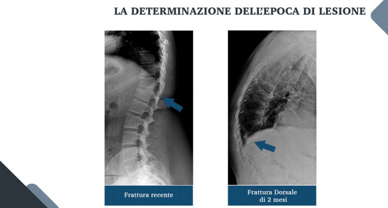 Le nuove frontiere della medicina forense. Gli infortuni ai raggi X: quando medico legale, avvocato e radiologo fanno gioco di squadra - Corriere Salentino