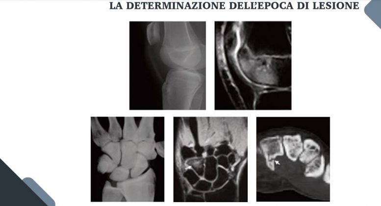 Le nuove frontiere della medicina forense. Gli infortuni ai raggi X: quando medico legale, avvocato e radiologo fanno gioco di squadra - Corriere Salentino
