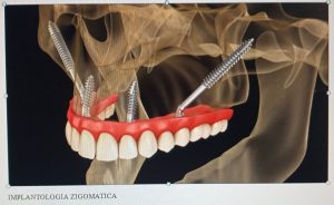 Intervista al professor Andrea Tedesco: due importanti e innovativi interventi di chirurgia odontoiatrica a Lecce - Corriere Salentino