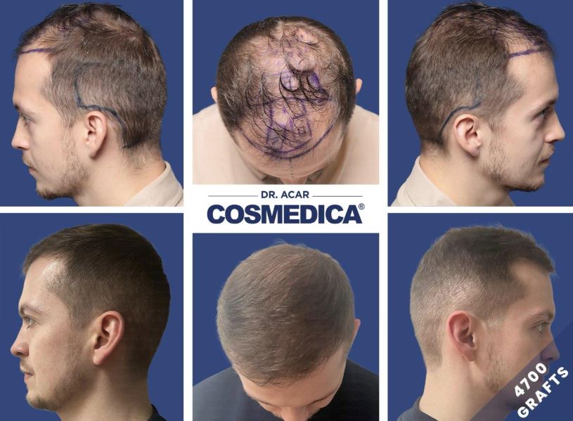 Trapianto Capelli in Turchia: Guida Completa al Turismo Medico Tricologico 2026 - Corriere Salentino