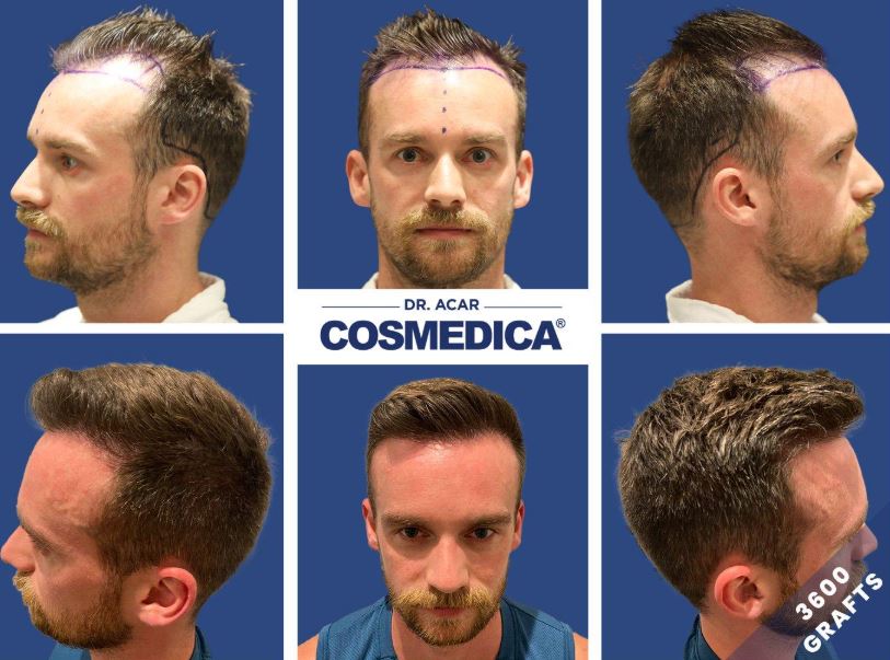 Trapianto Capelli in Turchia: Guida Completa al Turismo Medico Tricologico 2026 - Corriere Salentino